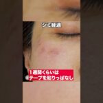 2024年　【質問にお答えします】シミは1回治療したら当日に取れますか？　#shorts #美容