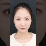 2024年　【垢抜け】美容整形でどこまで可愛くなれる？　#shorts #小顔  #クマ取り