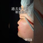 2024年　【二重整形】過去最大級の眼窩脂肪 #shorts