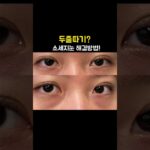 2024年　소세지눈재수술 방법은 두줄따기에 있다 #美容整形 #目元整形 #二重まぶた #二重整形