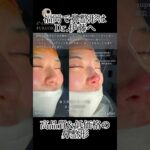 2024年　#鼻整形 #プロテーゼ #鼻尖形成 #小鼻縮小