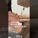 2024年　【ヒアルロン酸】プチ整形で横顔美人に⁉️